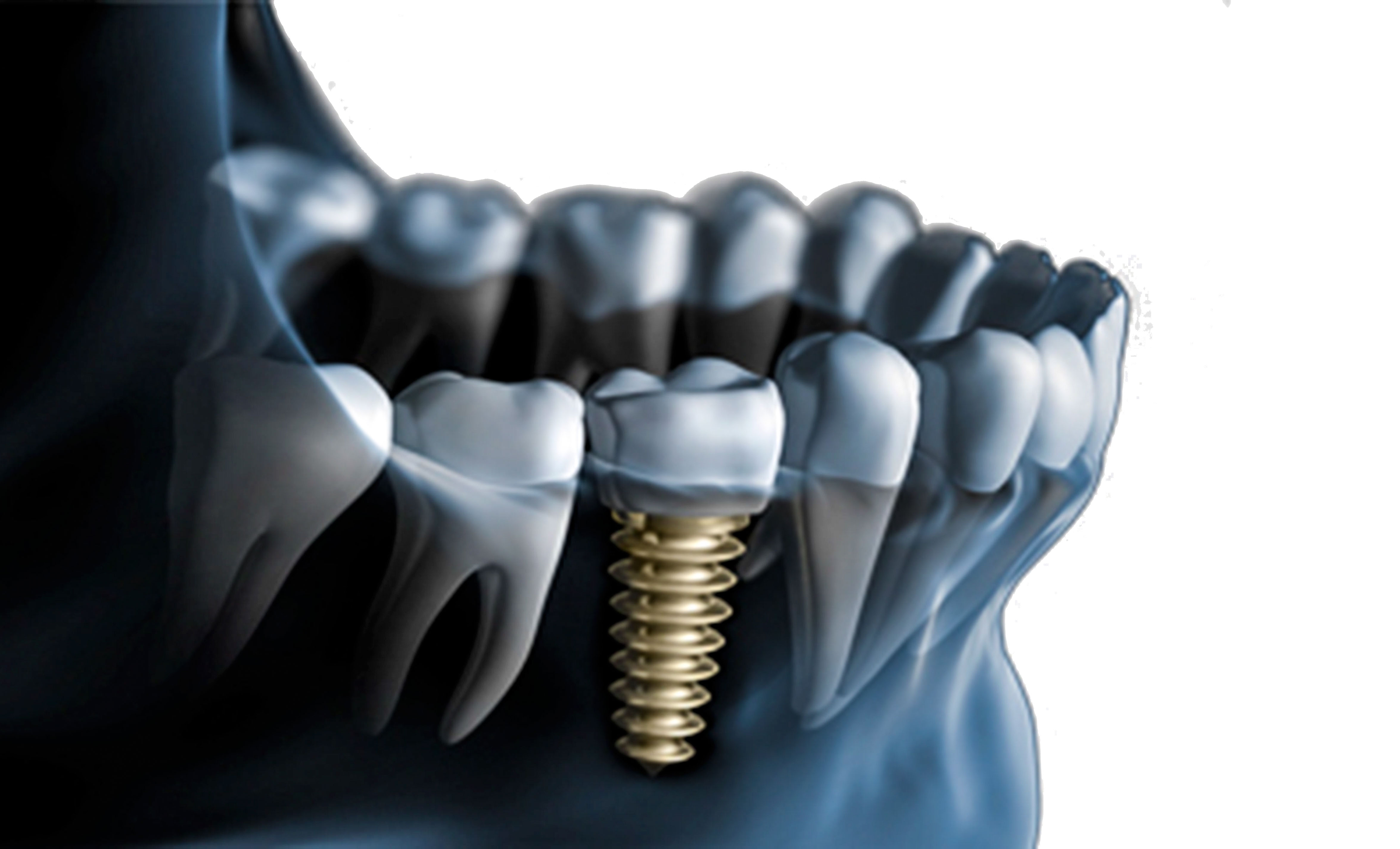 implante dentário maximus odontolgia - Maximus Odontologia