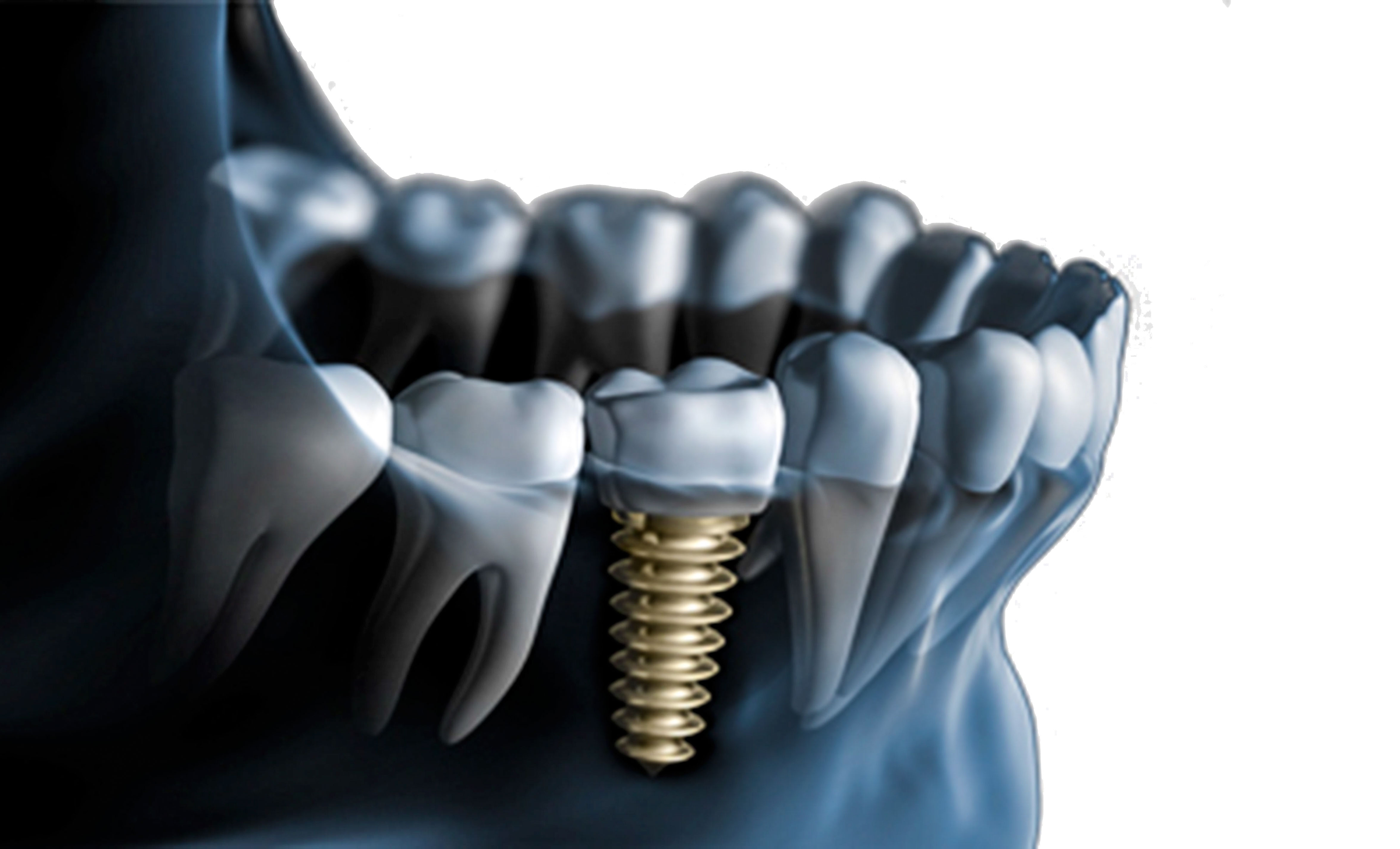 Implante Dentário Maximus Odontolgia Maximus Odontologia 0143