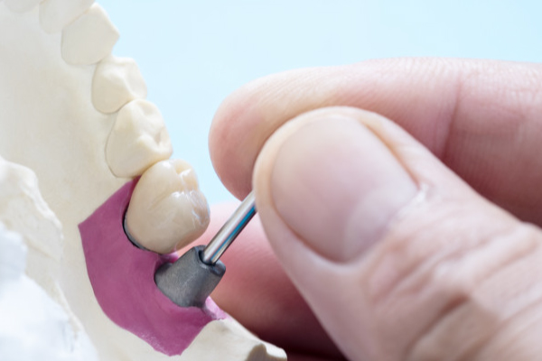 Implante Dentário Causa Mau Hálito?