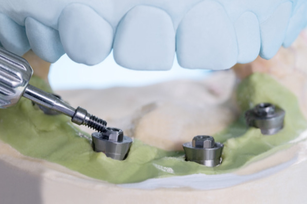 Posso Realizar Ressonância Magnética Com Implante Dentário?