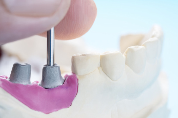 Quanto Tempo Dura Um Implante Dentário?
